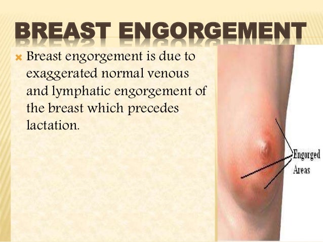 for breast engorgment For breast engorgment